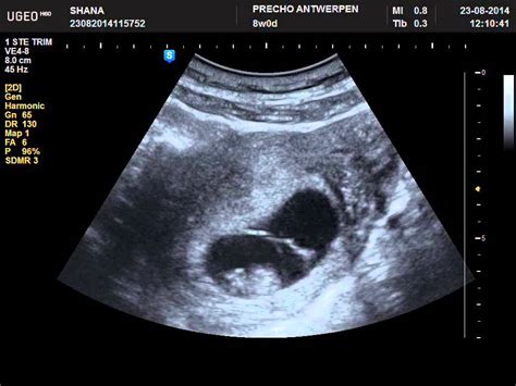 Baby At 8 Weeks Ultrasound - All You Need Infos