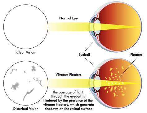 Vitreous Haemorrhage - Exeter Eye