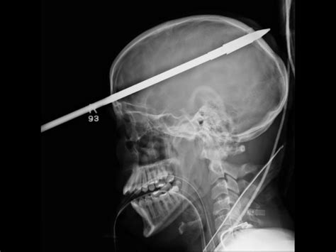 Teen survives spear impalement through skull - CBS News