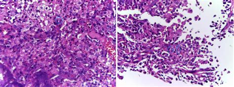 GASTROINTESTINAL AND LIVER HISTOLOGY PATHOLOGY ATLAS: COLON: MALAKOPLAKIA