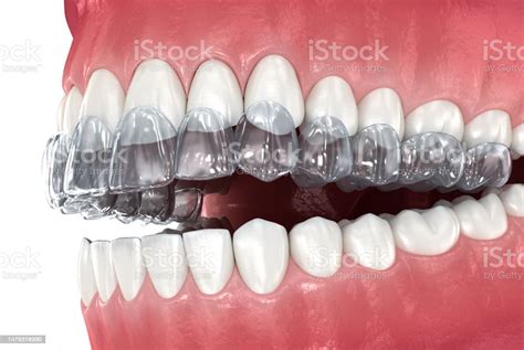 Bite Splint Bruxism Protection Medically Accurate Dental 3d Illustration Stock Photo - Download ...