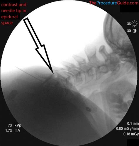 Fluoroscopic Guided Sitting Cervical Interlaminar (Midline) Epidural Steroid Injection ...