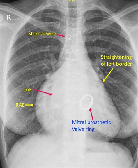 Mitral Valve Replacement Chest X Ray