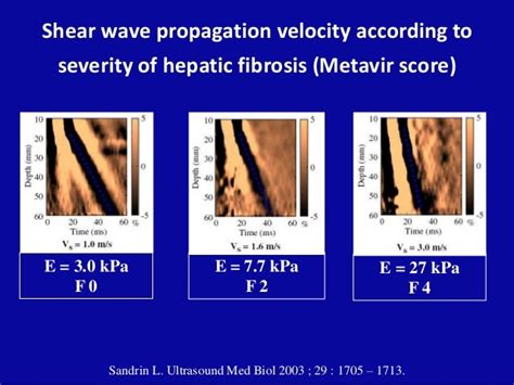 Fibroscan Liver Results