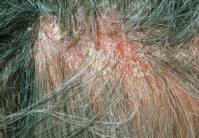 Severe dandruff on scalp of 50 year-old man - Stock Image - M140/0232 ...