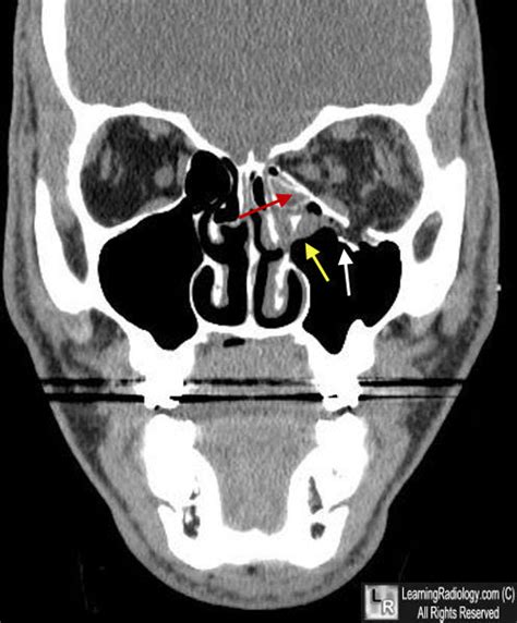 LearningRadiology - blowout, blow, out, fracture, orbit