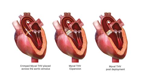 TAVR: A powerful ally in the battle against Aortic Valve Stenosis - Meril Life Blog