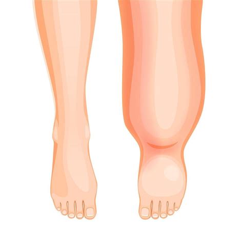 Edema foot disease, swollen leg symptom or problem 21948732 Vector Art at Vecteezy