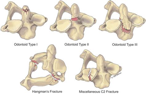 32 Trauma to the Craniovertebral Junction | Neupsy Key
