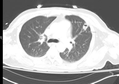 Gluteal abscess seeded by extension of psoas abscess via sciatic fistulization – Meyering Method