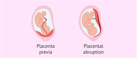 Complications in pregnancy due to problems in the placenta