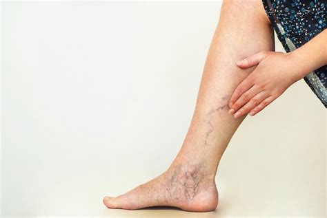 Bleeding Varicose Veins – Attention Leg Shavers and Shower Lovers - Avoid a Bloody Mess ...