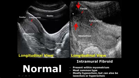 Uterus Ultrasound Normal Vs Abnormal Image Appearances Comparison ...