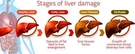 Liver Biopsy – Reasons, Preparation, Procedure & Results: Bharat Dasani ...