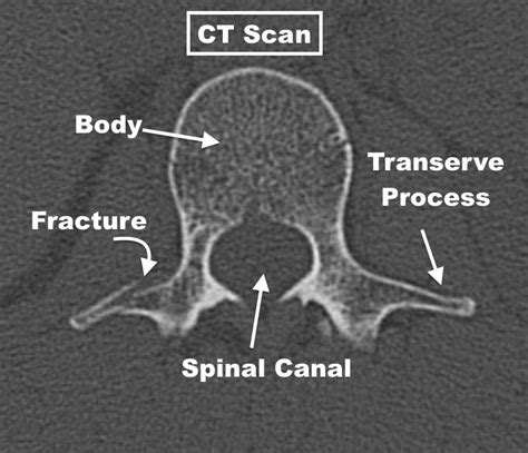 Transverse Process Spine Fracture