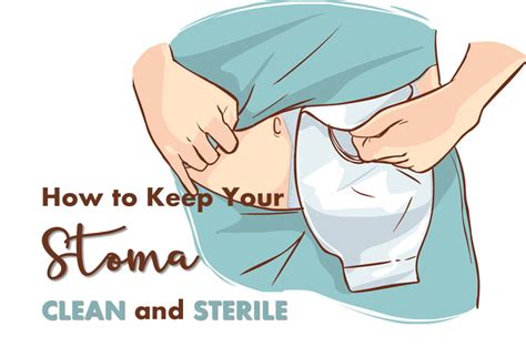 Taking Care of Your Stoma After an Ostomy - Patient's Lounge