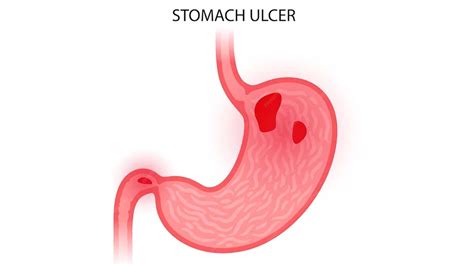 How are Stomach Ulcers Caused? – NutritionFact.in