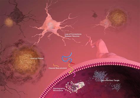 Yale breakthrough bolsters fight against Alzheimer's