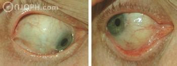 Ocular Cicatricial Pemphigoid