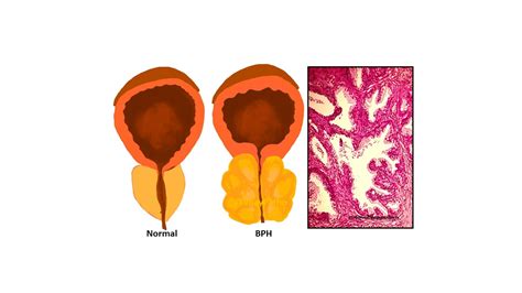 Benign prostatic hyperplasia(BPH) / Nodular hyperplasia of prostate ...