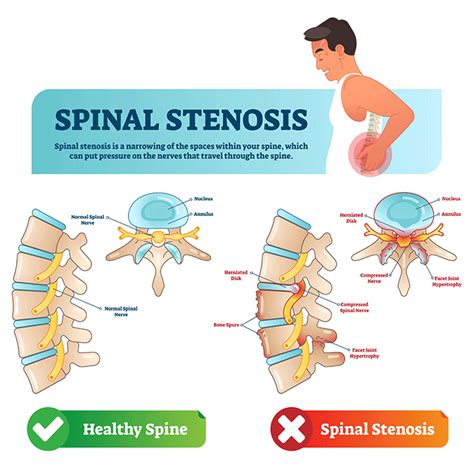 Spinal Stenosis: Symptoms & Causes | Och Spine at NewYork-Presbyterian