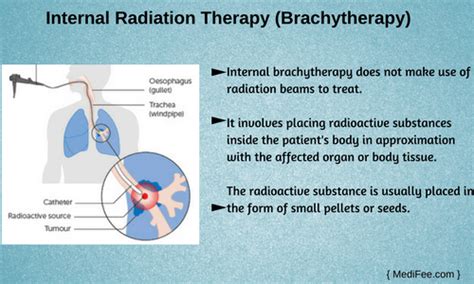 Radiation Therapy in India