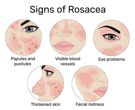 Rosacea - Valley Skin Institute