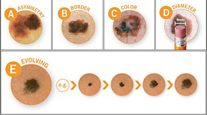 Melanoma - HPLAS