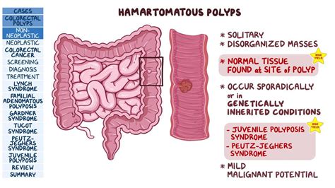 Hyperplastic Polyp Vs Adenomatous Polyp