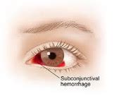 Eye Hemorrhage | The Connection Paper