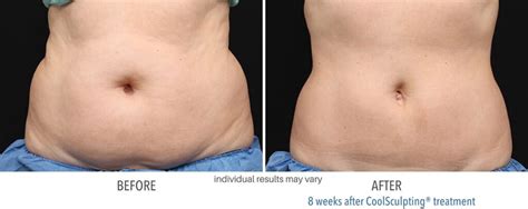 CoolSculpting® Before and After Stomach | Real Client Stories - Central Wellness Medical & Aesthetic