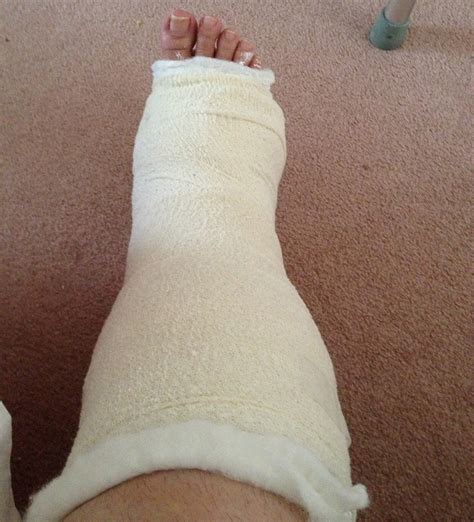 My Broken Ankle … Cast Issues … | Broken Creative Vegan