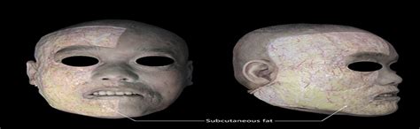 Clinical Anatomy of the Chin Evaluated by 3-Dimensional Tomo... : Dermatologic Surgery