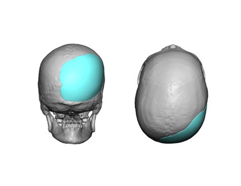 plagiocephaly Archives