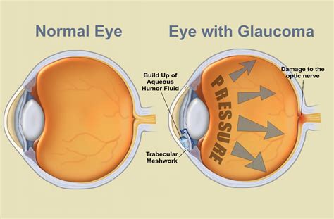 Open-Angle Glaucoma Sufferer's FAQ