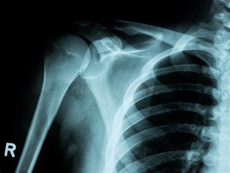 X-ray Image of Shoulder Fracture for a Medical Diagnosis Stock Photo ...