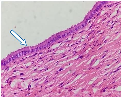 Nabothian cyst; inner cyst wall lined by single layer of ciliated low ...