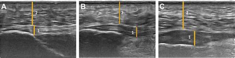 20+ Plantar Fascia Thickness - JuniorRoderick