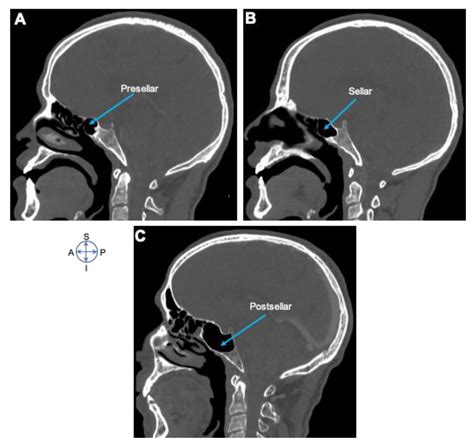 Sphenoid Sinus Pneumatization Types Radiology