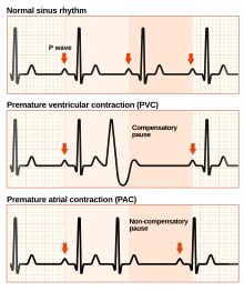 Premature Atrial Contractions