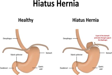 4 Lesser Known Facts About Hiatal Hernia - DFW Bariatrics and General Surgery