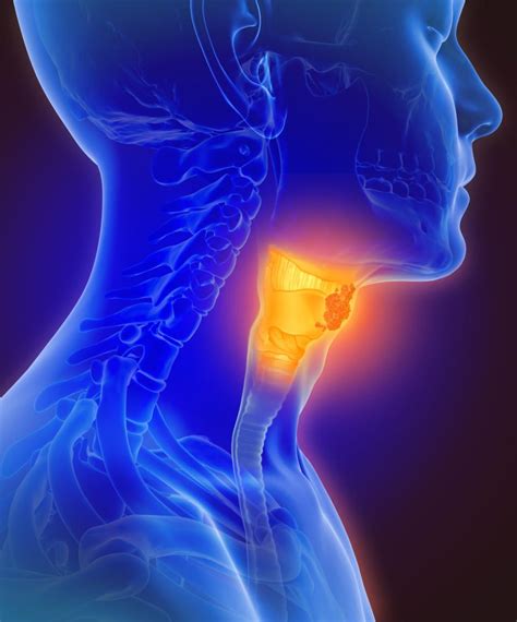 De-escalating radiation therapy for oropharynx cancer with FDG-PET • healthcare-in-europe.com