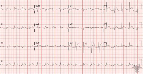 Acute Pericarditis | ECG Stampede