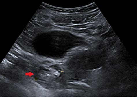 Cureus | Not Your Average Seizure: A Case of N-Methyl-D-Aspartate Receptor Encephalitis and ...