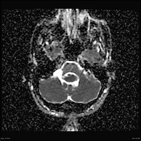 Mri T Axial View Showing Fourth Ventricle Ependymoma Download | SexiezPicz Web Porn