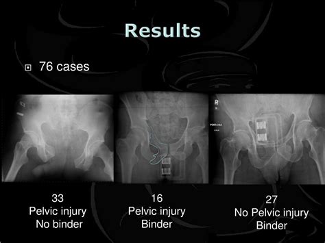 PPT - Is the Application of Pelvic Binders by Pre-Hospital Care Providers justified and ...