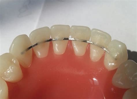 What is the difference between fixed retainer and removable retainer? | News | Dentagama