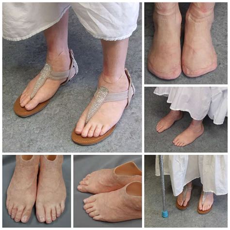 Toe & Foot Photo Gallery – Medical Art Prosthetics