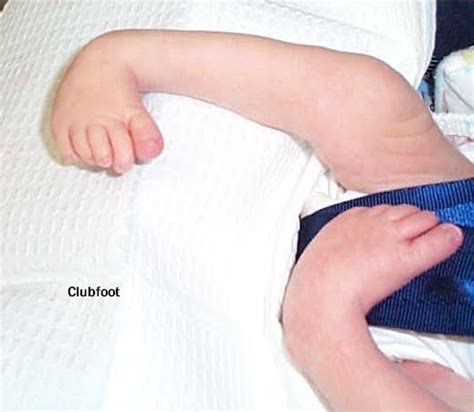 CTEV (Congenital Talipes Equinovarus) or Clubfoot | Treatment Zone