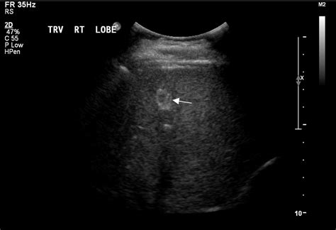 Hepatic Hemangioma on Ultrasound - radRounds Radiology Network